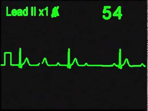 Bloqueo auriculoventricular de primer grado